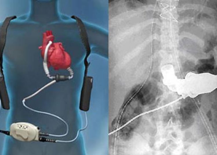 Multi-institutional study finds increased thrombosis in HeartMate II LVADs