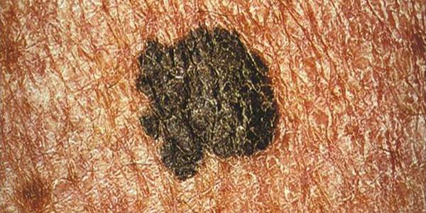melanoma