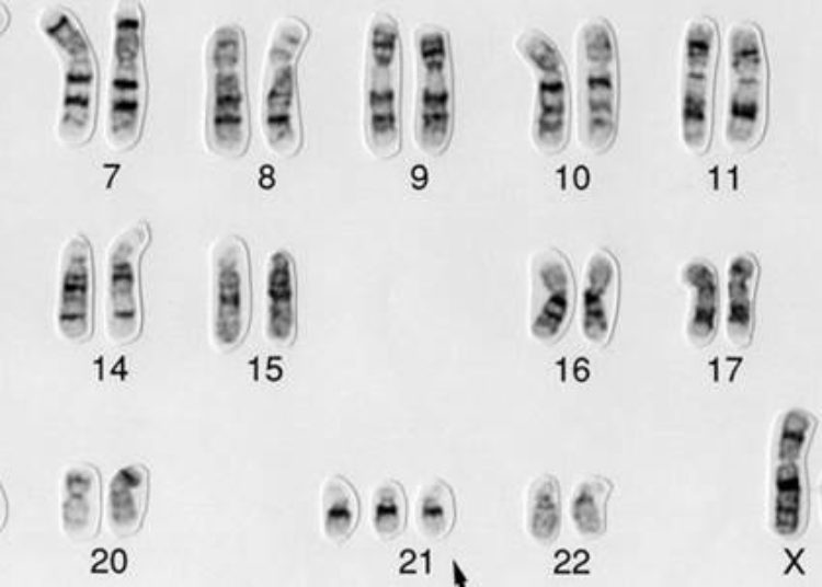 Maternal cell-free DNA sequencing superior to standard aneuploidy screening [CARE Study]