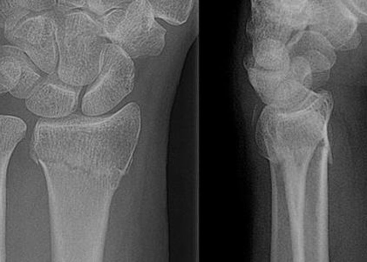 Fracture severity associated with treatment invasiveness for distal radius fractures