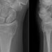 Fracture severity associated with treatment invasiveness for distal radius fractures