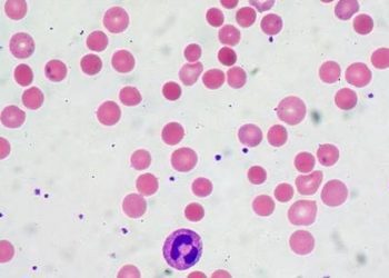 Complement mutation linked to poor response to eculizumab