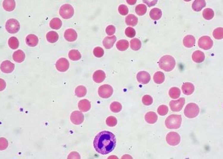 Complement mutation linked to poor response to eculizumab
