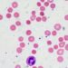 Complement mutation linked to poor response to eculizumab