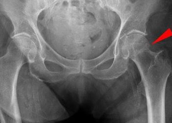 Home-based exercise after hip fracture rehabilitation improves mobility and balance