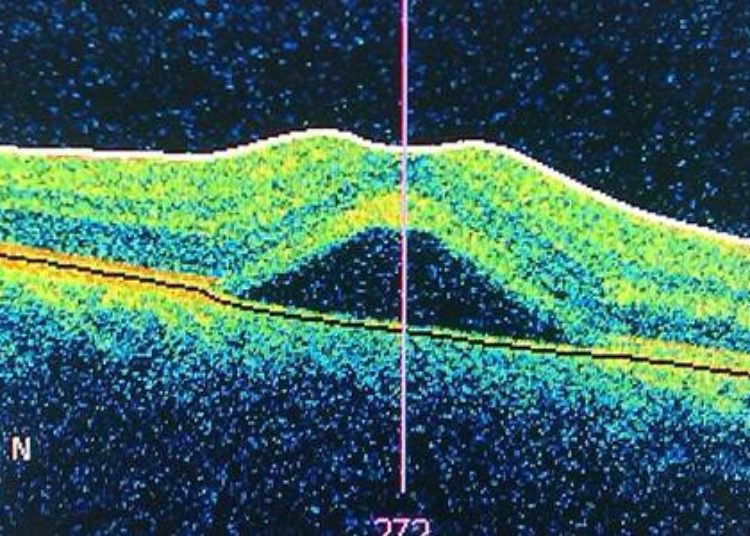 Retinopathy of prematurity associated with nonvisual impairment in childhood