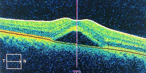 800px-Central_serous_retinopathy