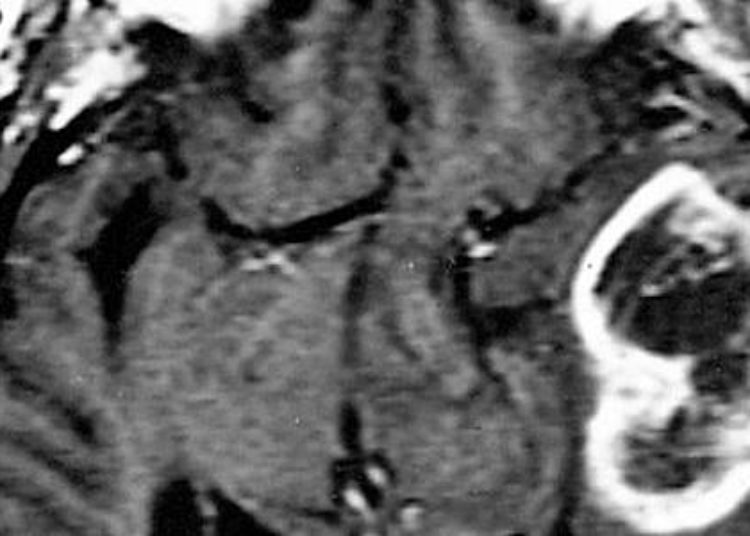 Addition of bevacizumab fails to benefit overall survival in newly diagnosed glioblastoma [RTOG 0825 trial]