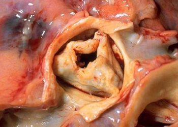 Transcatheter aortic valve replacement provides only minor benefit to quality of life