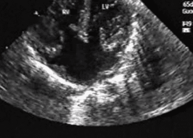Modified single-patch repair comparable to two-patch technique in infants with AVSD
