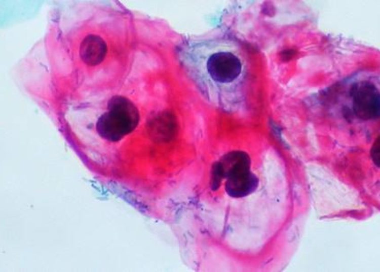 Reduced doses of human papillomavirus vaccine may be effective in preventing condyloma