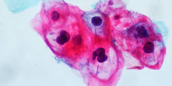 CIN_1-HPV_on_ThinPrep