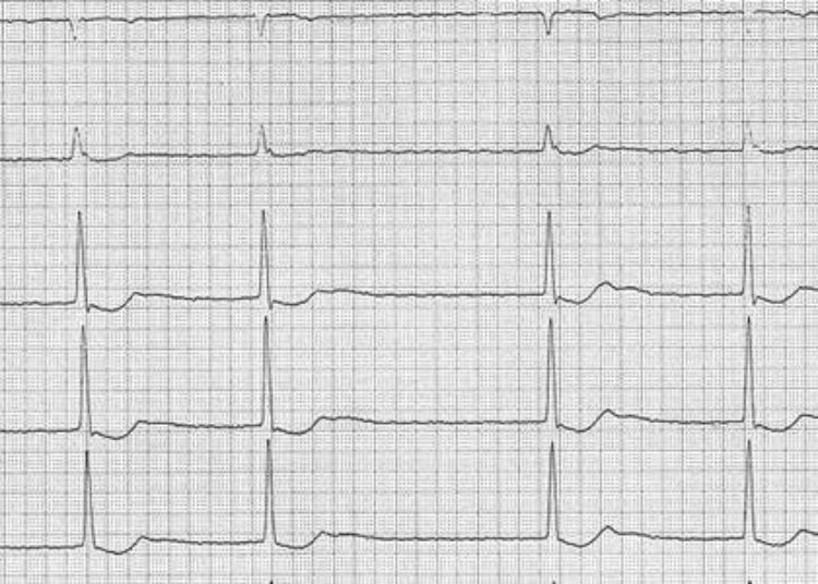 Radiofrequency catheter ablation effective as first-line therapy for atrial fibrillation [RAAFT-2 trial]