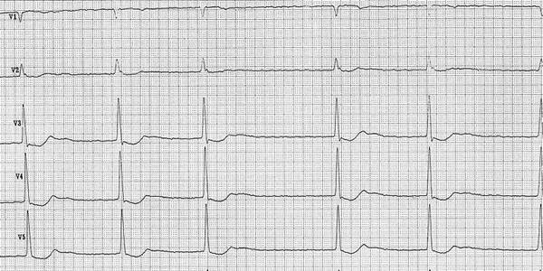 atrial fibrillation