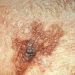 Video-based behavioral intervention benefits clinical skin examinations