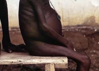 Minimal association between economic growth and childhood undernutrition for world’s poorest