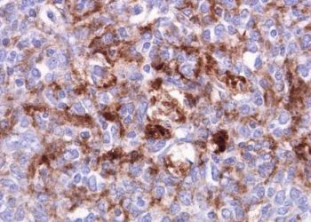 Novel screening test may benefit variant Creutzfeldt-Jakob Disease patients