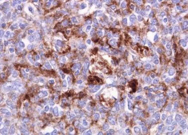 Novel screening test may benefit variant Creutzfeldt-Jakob Disease patients