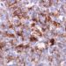 Novel screening test may benefit variant Creutzfeldt-Jakob Disease patients