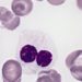 Entinostat plus azacitidine may not improve response for myelodysplastic syndrome