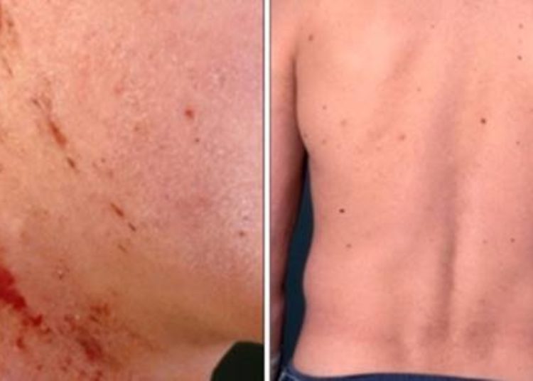 Various factors impact quality of life in patients with chronic pruritus