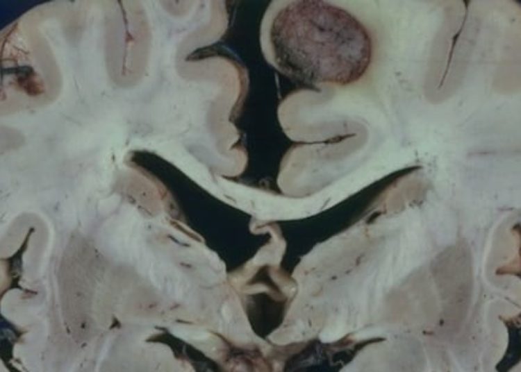 Stereotactic radiosurgery promising for patients with multiple brain metastases