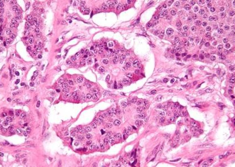 Neuroendocrine tumor marker pancreastatin may be predictive of survival