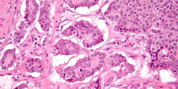 600px-Small_intestine_neuroendocrine_tumour_high_mag