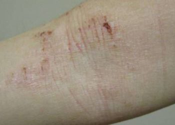 Atopic dermatitis may be more persistent than previously understood
