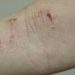 Atopic dermatitis may be more persistent than previously understood
