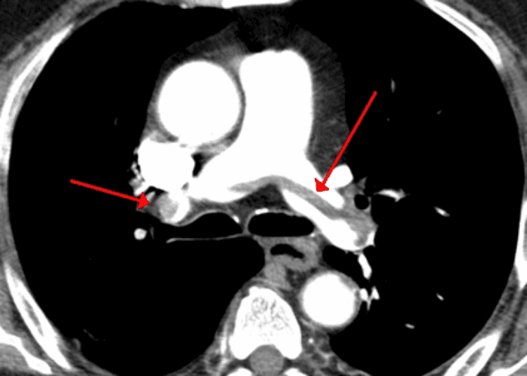 Fibrinolysis for pulmonary embolism may prevent hemodynamic collapse [PEITHO trial]