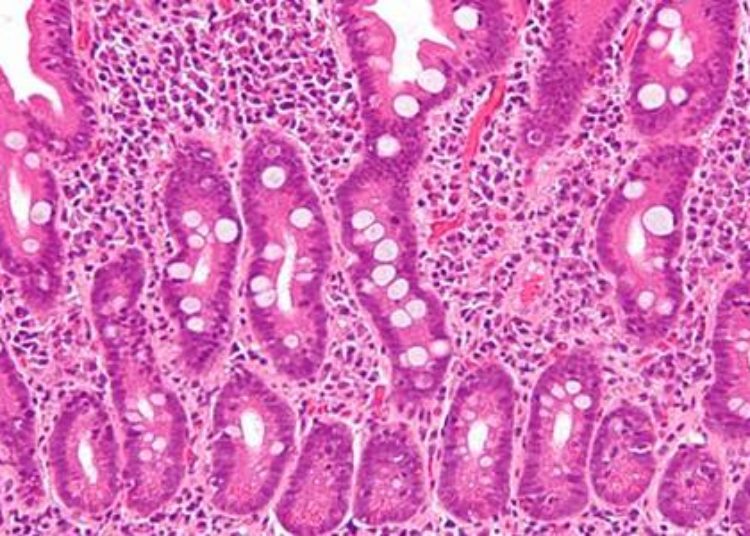 Celiac disease more prevalent in children with irritable bowel syndrome