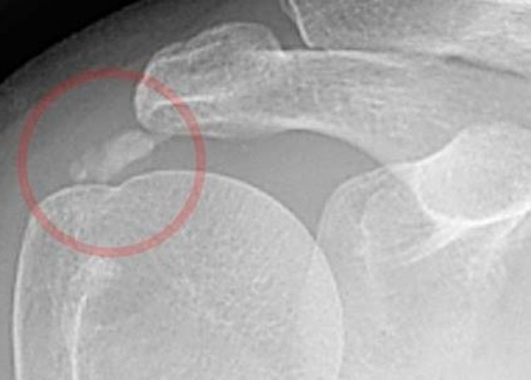 High-energy shockwave therapy effective in treating shoulder calcific tendinitis