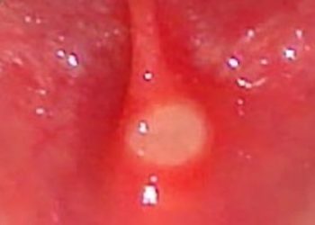 Doxepin rinse reduces pain of oral mucositis during radiotherapy