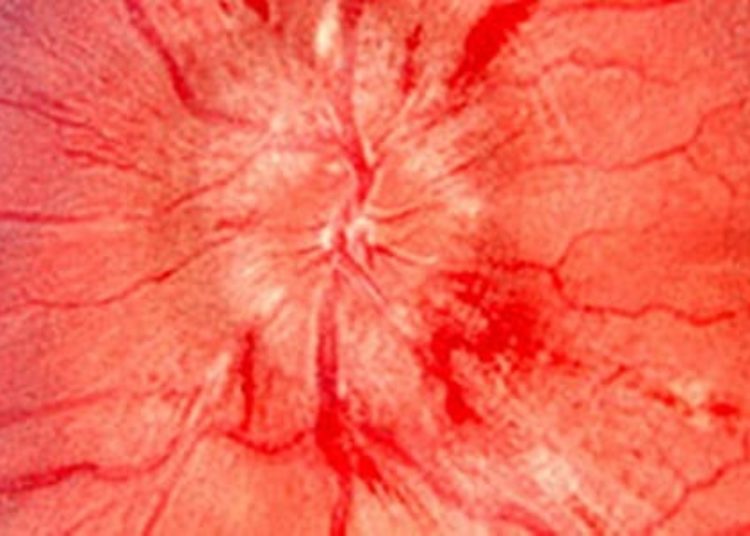 Idiopathic intracranial hypertension: Key signs and symptoms characterized