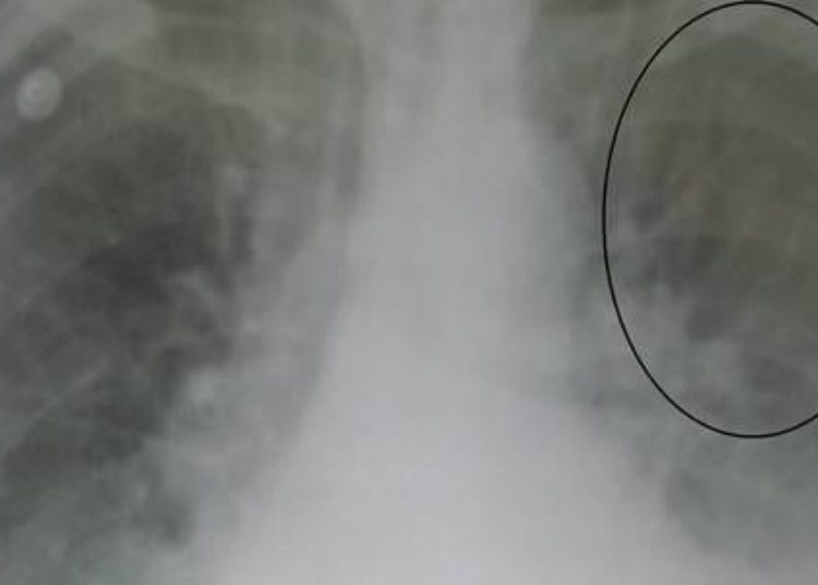Spironolactone not beneficial in heart failure with preserved ejection fraction [TOPCAT trial]