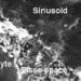 HLA-DRB1*07:01 confirmed as risk factor for lapatinib-induced liver damage