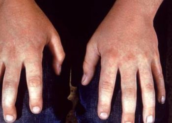 Four rash patterns common in adults with parvovirus infection