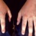 Four rash patterns common in adults with parvovirus infection