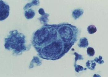 Letermovir safe, effective in CMV prophylaxis following stem-cell transplantation