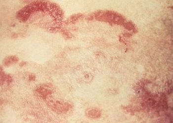 Bath psoralen plus ultraviolet A shows good efficacy in the treatment of mycosis fungoides
