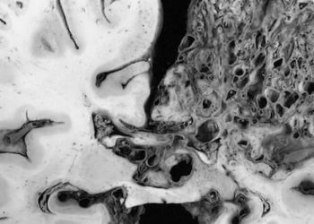 Radiosurgery alone may be effective for some arteriovenous malformations