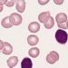 Combined lenalidomide and rituximab dose escalation found to be safe for CLL