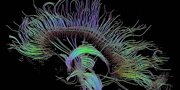 Mr neuropathy