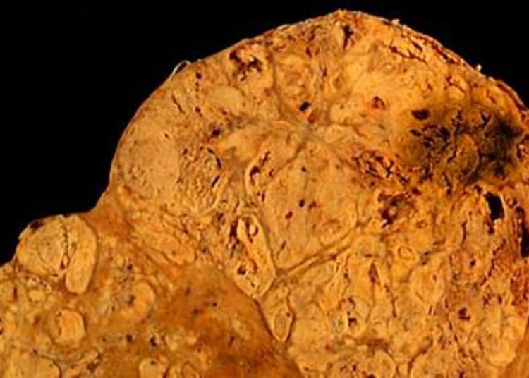 Tumor size, chemoembolization response may predict hepatocellular carcinoma recurrence