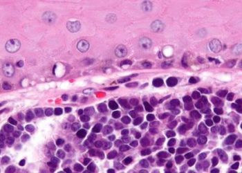 Key predictors of recurrence and survival for Merkel Cell Carcinoma elucidated