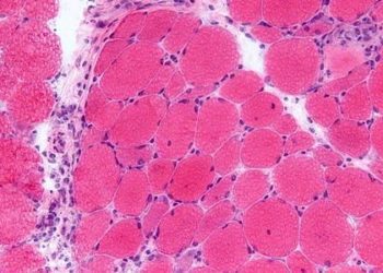 dermatomyositis