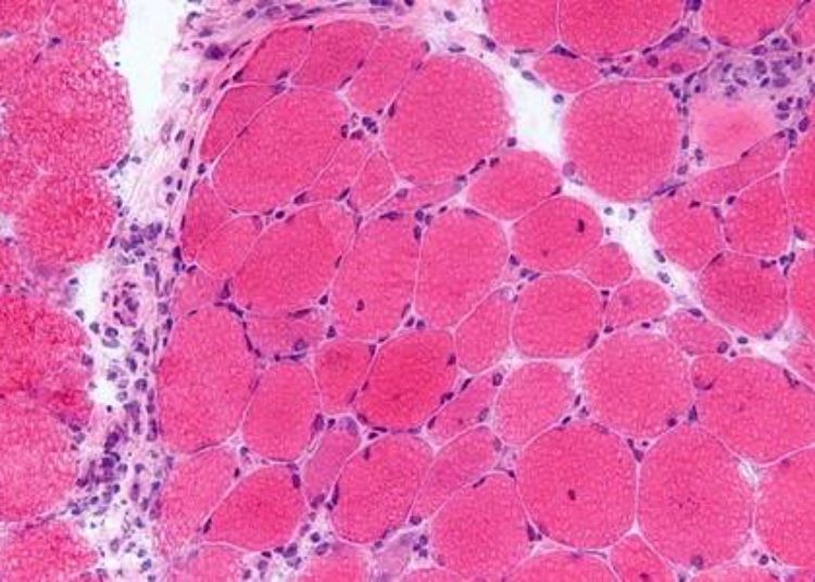 dermatomyositis