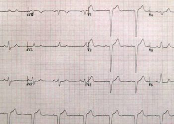 Cardiac Resynchronization Therapy may be more beneficial in women
