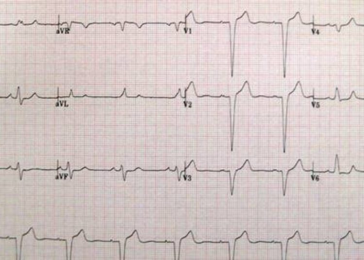 Cardiac Resynchronization Therapy may be more beneficial in women